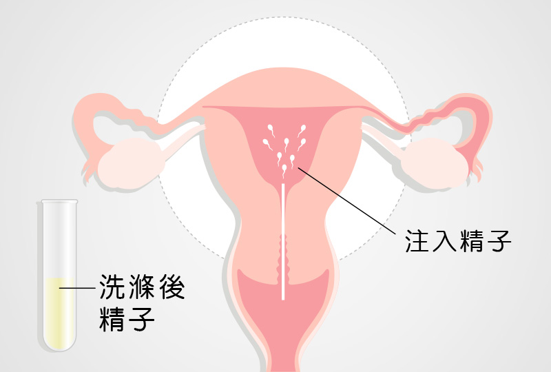 人工受精-安安试管婴儿中心,不孕症,试管婴儿,人工受孕,冷冻卵子